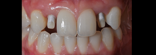 implantologia y estetica