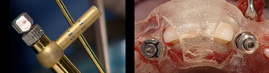 implantologia y estetica