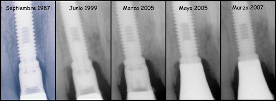 implantologia