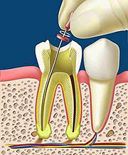 endodoncia